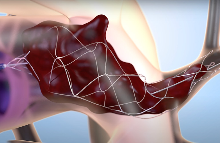 Ілюстрація, на якій показано нітиноловий каркас Flow Medical, що розширюється всередині згустку.