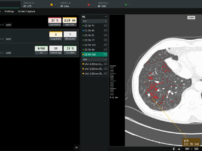 Скринінг раку легенів Coreline Soft AI додала до Calantic Platform Bayer