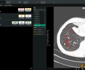 Скринінг раку легенів Coreline Soft AI додала до Calantic Platform Bayer