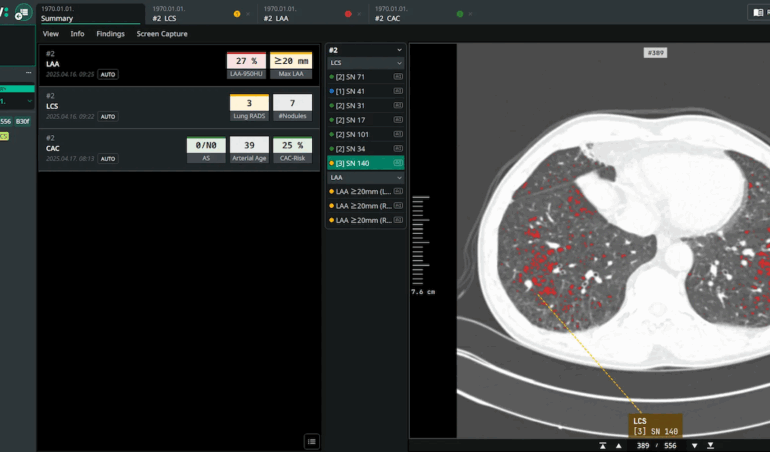 Скринінг раку легенів Coreline Soft AI додала до Calantic Platform Bayer