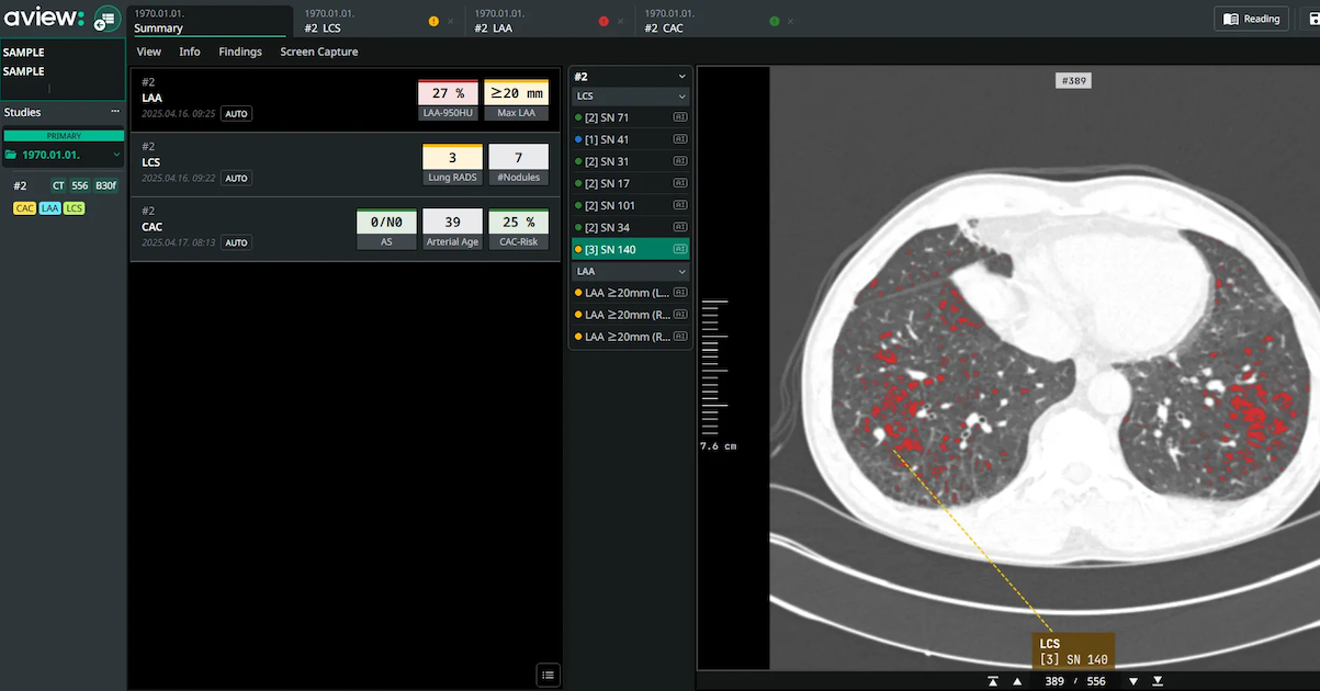 Скринінг раку легенів Coreline Soft AI додала до Calantic Platform Bayer