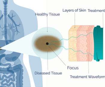 Чи може Пелюстка скоротити порізи після операції?