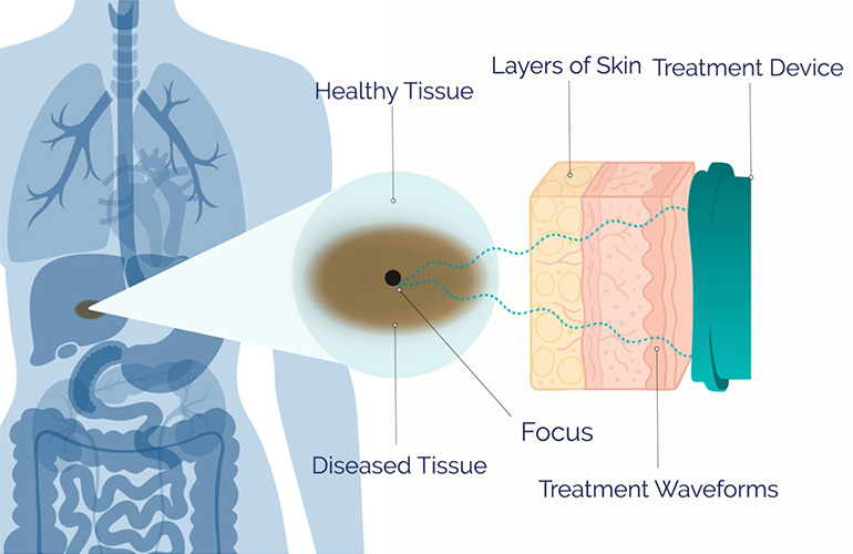 Чи може Пелюстка скоротити порізи після операції?