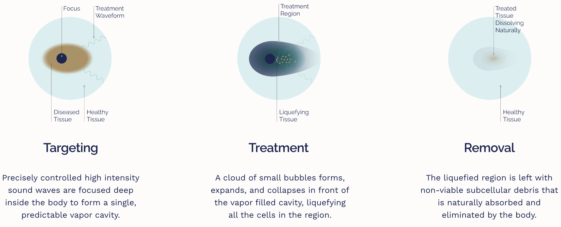 Ілюстрація, що пояснює акустичне розрідження: націлювання (точно контрольовані звукові хвилі високої інтенсивності фокусуються глибоко всередині тіла, щоб утворити єдину передбачувану парову порожнину), лікування (хмара маленьких бульбашок утворюється, розширюється та згортається перед заповненою парою порожниною, розріджуючи всі клітини в цьому регіоні) та видалення (зріджена область залишається нежиттєздатною). субклітинний дебрис, який природним чином поглинається та виводиться організмом).